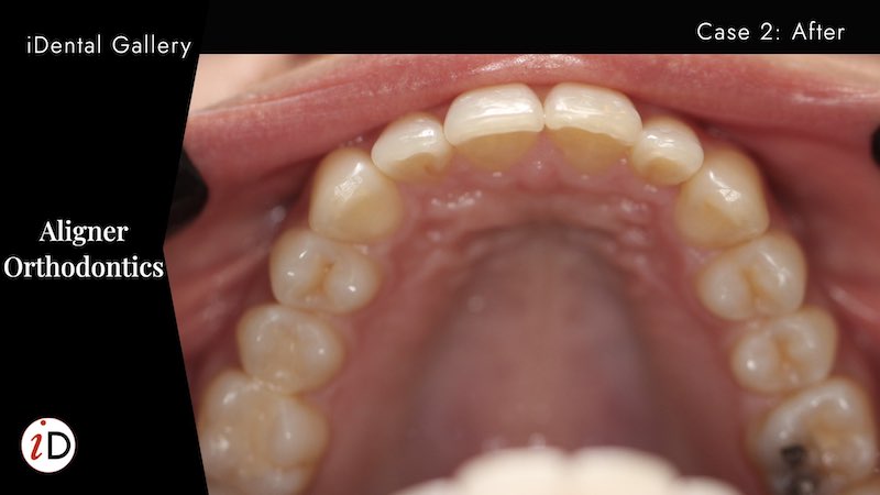 ALIGNERS | CASE 2 | AFTER